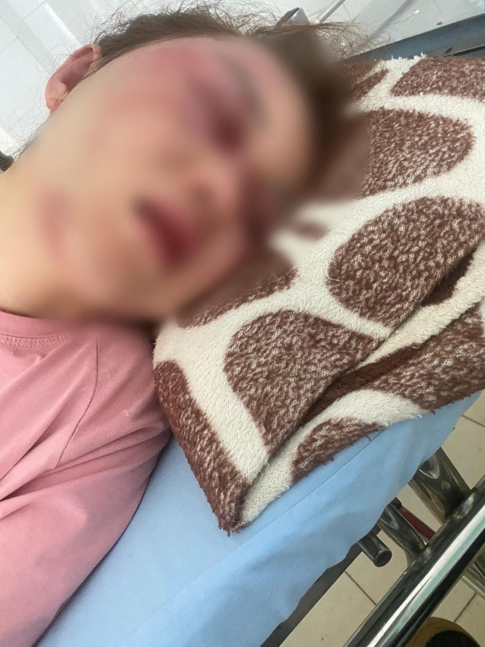 Nhiều vết thương trên khuôn mặt chị N.