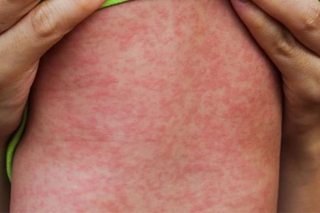 Dịch sởi đang có dấu hiệu bùng phát trở lại với số ca mắc gia tăng nhanh tại nhiều địa phương. Dịch sởi đang có dấu hiệu bùng phát trở lại với số ca mắc gia tăng nhanh tại nhiều địa phương.