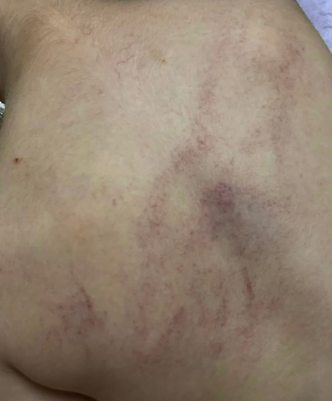 Theo phản ánh của phụ huynh, lưng của trẻ tím bầm sau khi bị giáo viên Trường mầm non Gia Thuỵ đánh. Theo phản ánh của phụ huynh, lưng của trẻ tím bầm sau khi bị giáo viên Trường mầm non Gia Thuỵ đánh.