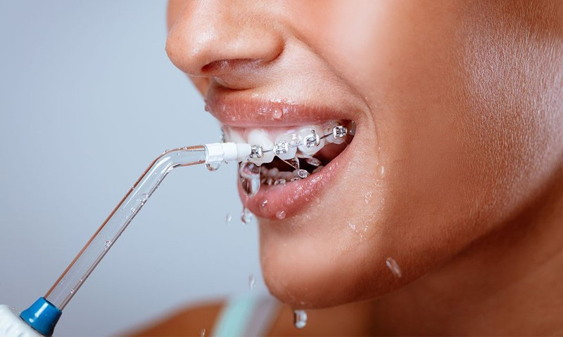 Chăm sóc răng miệng khi niềng răng là rất quan trọng để kết quả điều trị chỉnh nha được tối ưu nhất. Ảnh minh họa: Internet