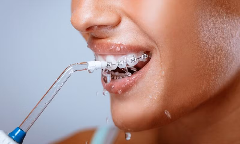 Chăm sóc răng miệng khi niềng răng là rất quan trọng để kết quả điều trị chỉnh nha được tối ưu nhất. Ảnh minh họa: Internet