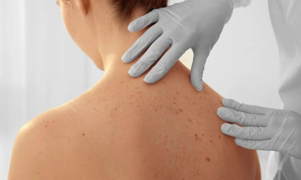 Tia UV (tia cực tím) từ ánh nắng mặt trời là nguyên nhân chính gây ung thư tế bào vảy. Những người tiếp xúc thường xuyên với ánh nắng mặt trời, đặc biệt là trong thời gian dài, có nguy cơ mắc ung thư này cao hơn. Ảnh minh họa: Internet