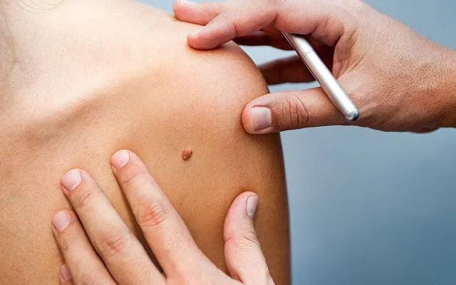 Ung thư da là một trong các ung thư thường gặp và khá dễ chẩn đoán. Ung thư da (không kể ung thư hắc tố) là các ung thư xuất phát từ biểu mô da che phủ mặt ngoài cơ thể, gồm nhiều lớp tế bào. Ảnh minh họa: Internet