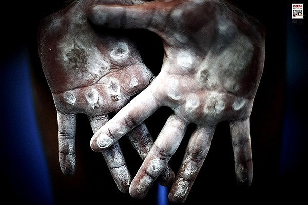 Vết chai sần trên đôi tay những VĐV Thể dục dụng cụ