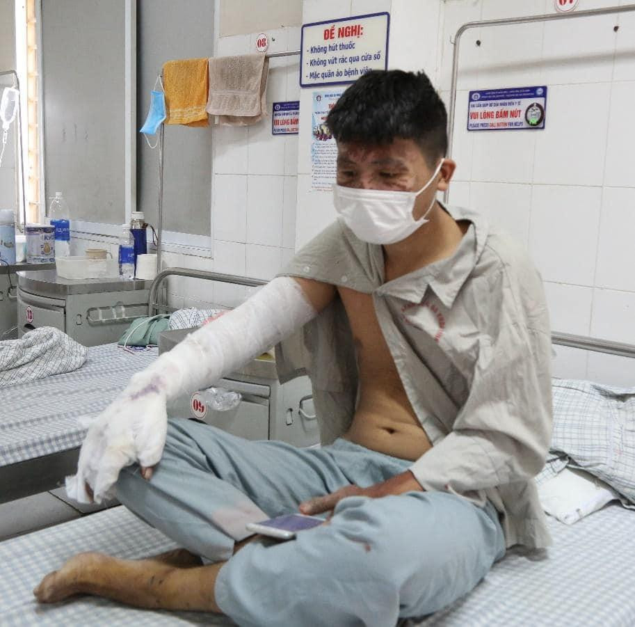 Nam thanh niên bị bỏng và tổn thương nhiều vị trí trên cơ thể do nổ bình gas mini. Ảnh: BS cung cấp