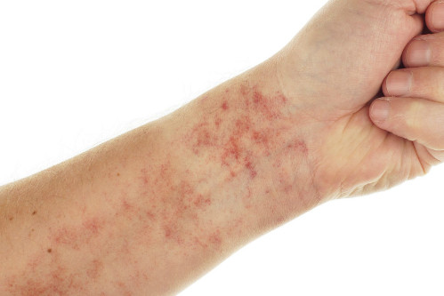 12 dấu hiệu cảnh báo bệnh lupus ban đỏ ảnh 2