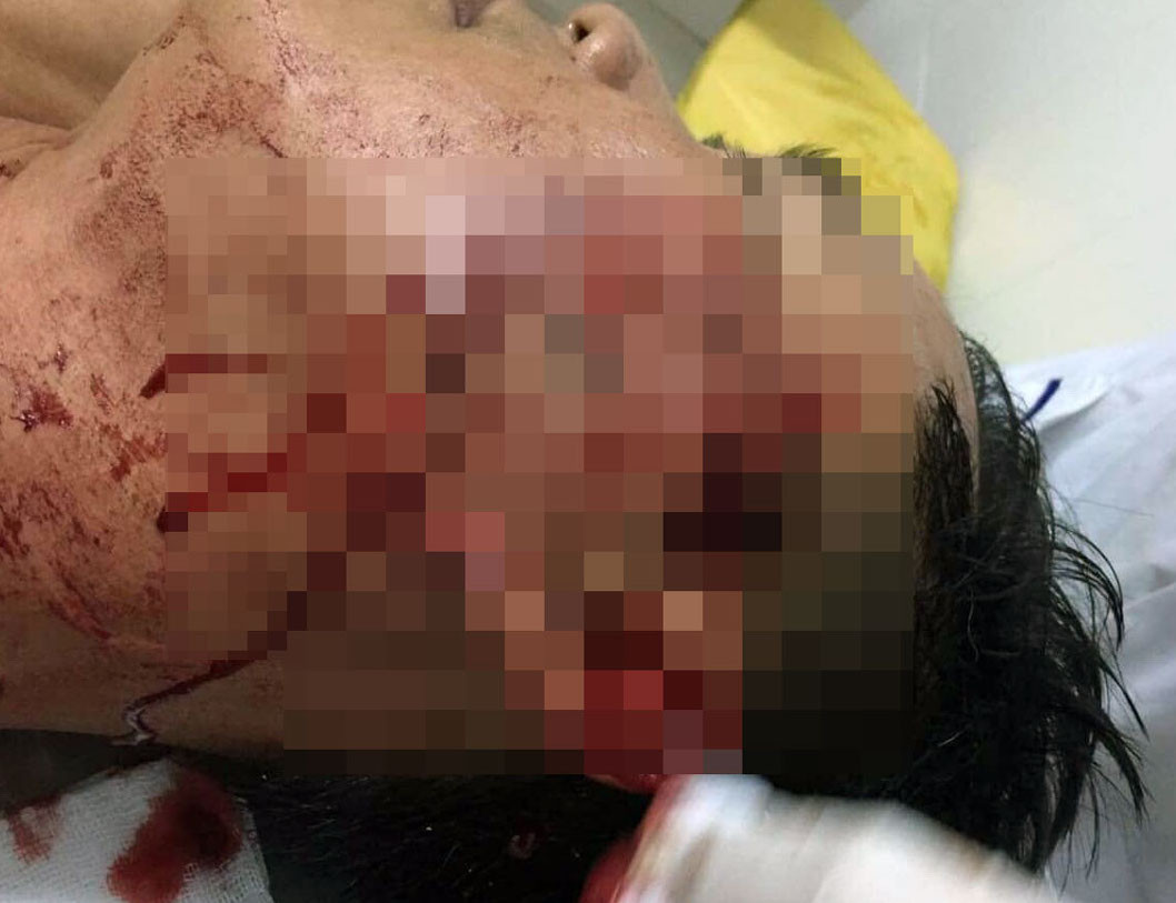  Đại úy công an bị nam thanh niên đánh thương tích trong quán nhậu ảnh 1