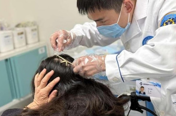 Răng kẹp càng cua ghim vào đầu người phụ nữ. Ảnh: 363Hospital. Răng kẹp càng cua ghim vào đầu người phụ nữ. Ảnh: 363Hospital.