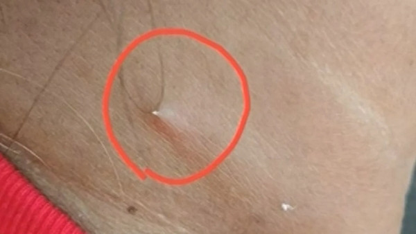 Cái xương cá xuyên qua da. Ảnh: Channel 3. Cái xương cá xuyên qua da. Ảnh: Channel 3.