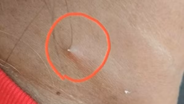 Cái xương cá xuyên qua da. Ảnh: Channel 3. Cái xương cá xuyên qua da. Ảnh: Channel 3.