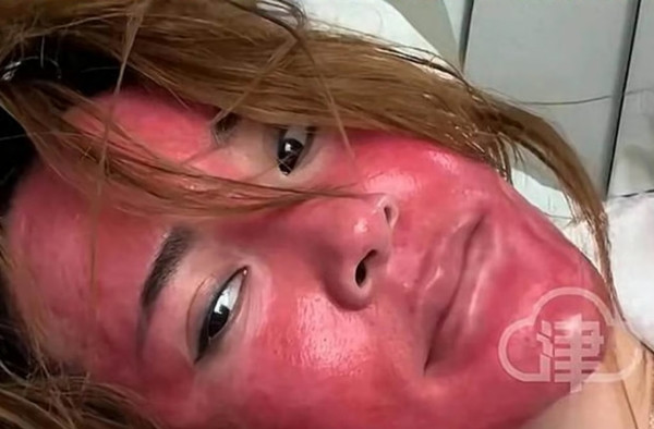 Làn da bị viêm nặng của người phụ nữ 22 năm không tẩy trang kỹ càng. Ảnh: Weibo.