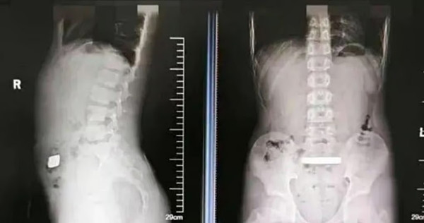 Hình chụp X-quang cho thấy vật thể kim loại nằm trong đường ruột của bé Qian. Ảnh: Douyin.
