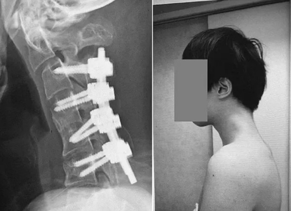 Phải sau nhiều ca phẫu thuật và dùng đến các thanh kim loại thì tình trạng của bệnh nhân mới được cải thiện thế này. Ảnh: ScienceDirect.