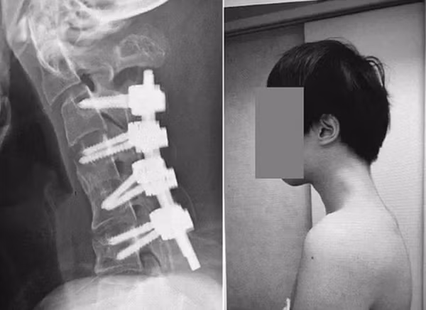 Phải sau nhiều ca phẫu thuật và dùng đến các thanh kim loại thì tình trạng của bệnh nhân mới được cải thiện thế này. Ảnh: ScienceDirect.