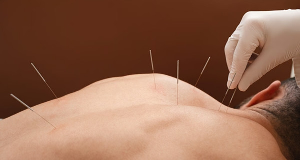 Bác sĩ nói, vì bị châm cứu sai cách, anh Gao chỉ vào viện chậm 1 phút thôi là có thể mất mạng rồi. Ảnh minh họa: Shutterstock.