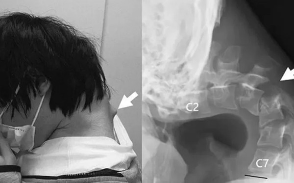 Tình trạng cổ của bệnh nhân khi gặp bác sĩ. Ảnh: ScienceDirect.