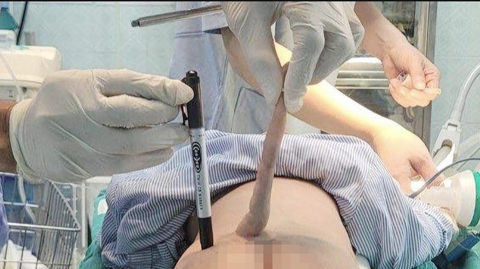 Các bác sĩ tiến hành ca phẫu thuật cắt bỏ phần đuôi dị tật (Ảnh: Bệnh viện Nhi Thanh Hóa).