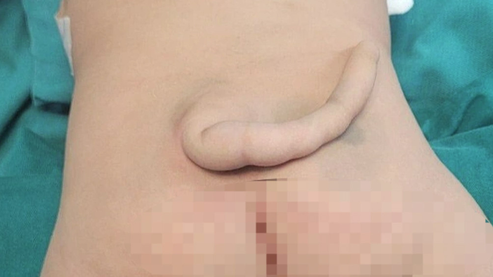 Hình ảnh bé trai 4 tháng tuổi nhập viện với cái đuôi bất thường ở vùng cùng cụt (Ảnh: Bệnh viện Nhi Thanh Hóa).