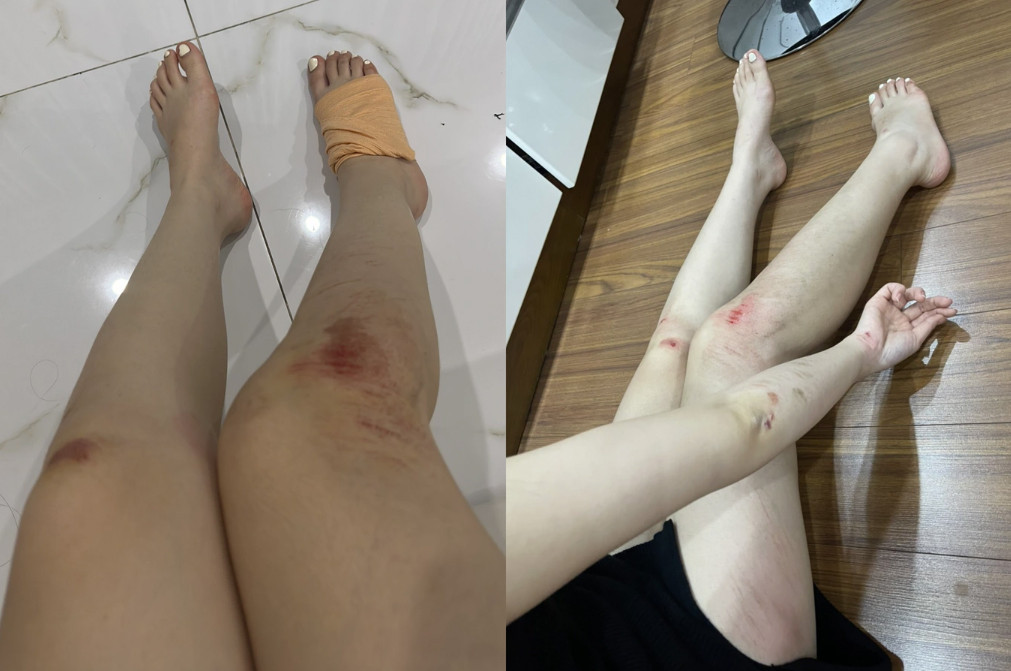 Sau va chạm, N. bị bong gân, trầy xước hai chân và hai tay (Ảnh: Nhân vật cung cấp).