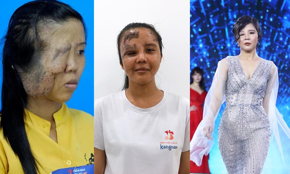 Diệu Thúy đã loại bỏ được khối u lớn trên mặt