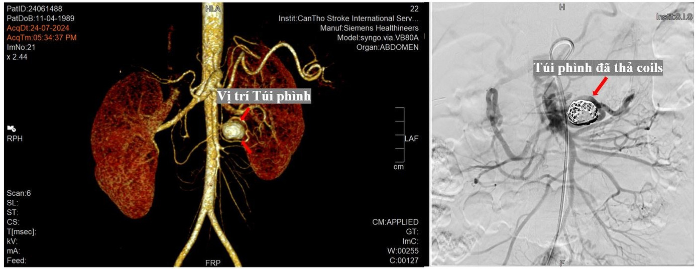 Hình ảnh túi phình động mạch ruột trước và sau can thiệp ở bệnh nhân