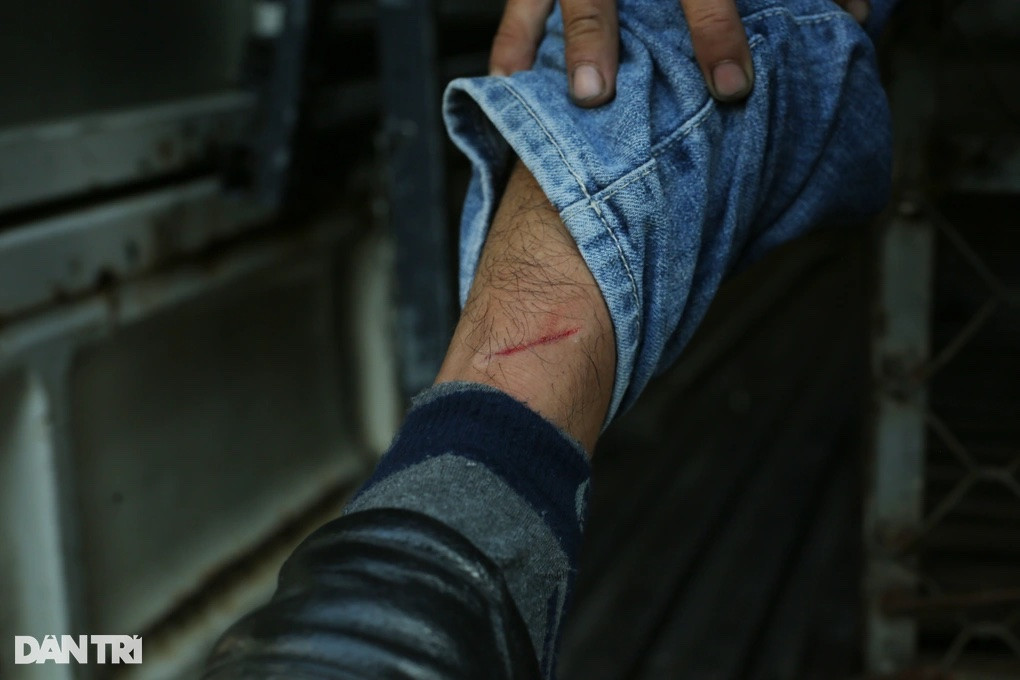 Chân của một cán bộ phường bị thương do bị chó cắn (Ảnh: An Huy).