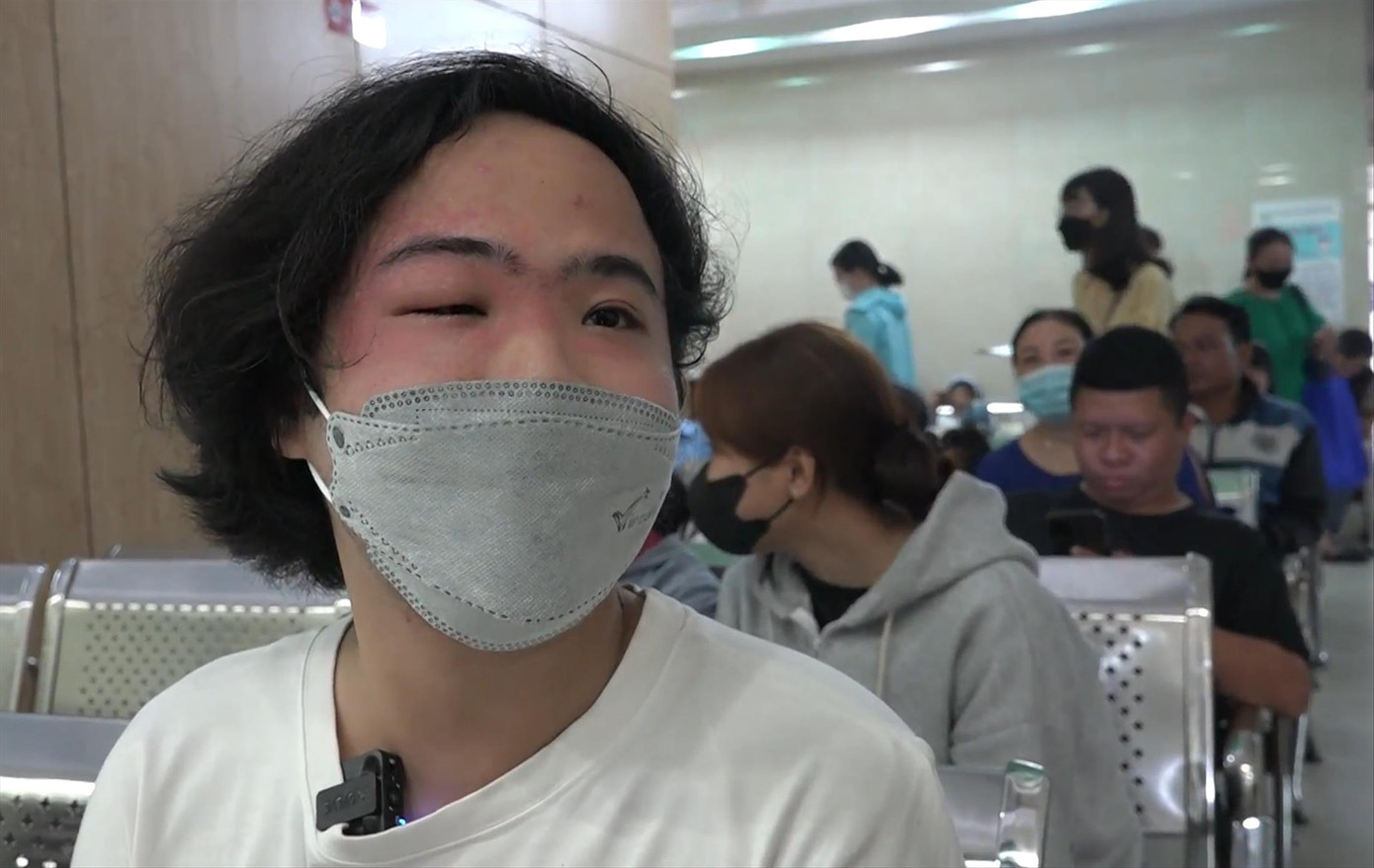 Một bệnh nhân bị tổn thương da vùng mặt do độc tố kiến ba khoang gây ra. Ảnh: Lan Anh