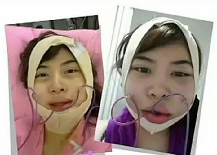 Sau ca phẫu thuật, khuôn mặt của bệnh nhân đã sưng phồng lên trông như một quả bóng được thổi to