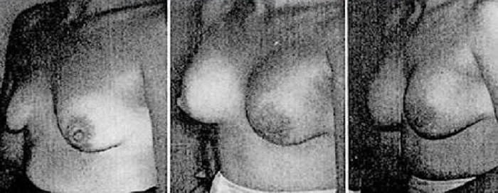 Đây là công nghệ do bác sỹ Frank Gerow người Canada tại Bệnh viện Jefferson Davis kết hợp với bác sĩ Thomas Cronin phát triển công nghệ nâng ngực cho những phụ nữ cảm thấy tự ti về bộ ngực lép kẹp sau khi sinh con