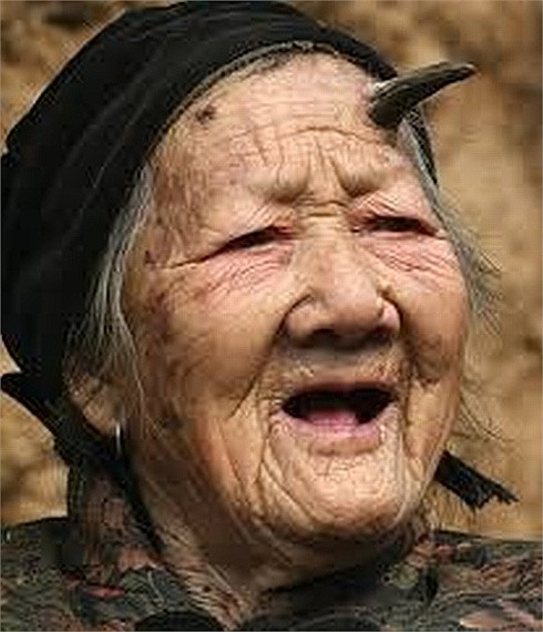  Sừng da xuất hiện như hình phễu kéo dài từ một chấm đỏ trên da. Kích thước và hình dạng có thể thay đổi đáng kể, nhưng hầu hết là dài vài mm