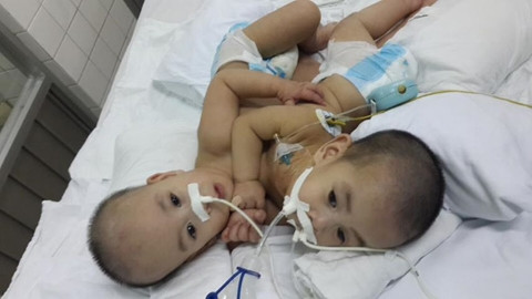 Bé Phi Long, Phi Phụng được nuôi dưỡng tại khoa Hồi sức – tích cực suốt 14 tháng