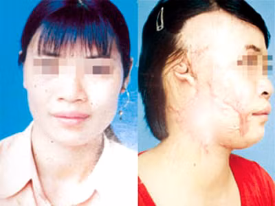 Ảnh của nạn nhân trước và sau khi bị tạt axit. Ảnh của nạn nhân trước và sau khi bị tạt axit