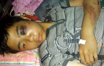 Học sinh Phan Lê Hiệp bị thương tích khắp người phải nhập viện để điều trị từ nhiều ngày qua. (Ảnh chụp ngày 17-4