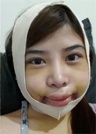 Theo các chuyên gia phẫu thuật, vết sưng sẽ giảm 70 - 80% sau từ 1 đến 2 tuần