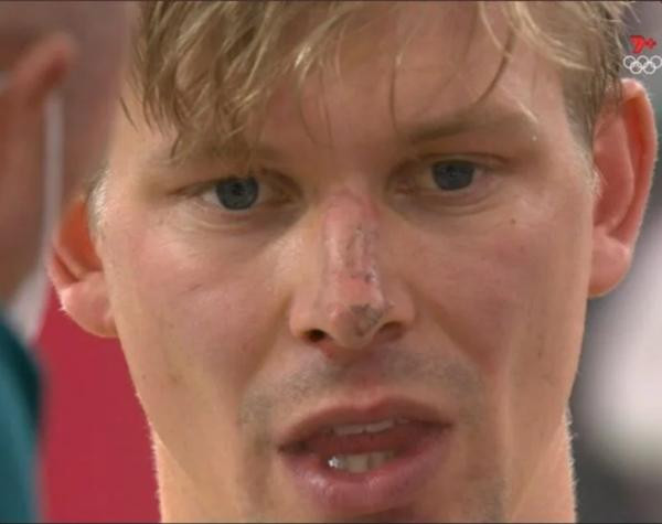 Porter trầy trụa sau khi ngã. Ảnh: GMS.