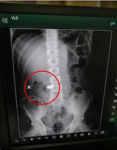 Phim chụp X-quang của Vijay. Ảnh: News18. Phim chụp X-quang của Vijay. Ảnh: News18.