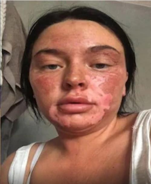 Conway hiện tại, sau khi bị bỏng vì chần trứng trong lò vi sóng. Ảnh: Chantelle Conway. Conway hiện tại, sau khi bị bỏng vì chần trứng trong lò vi sóng. Ảnh: Chantelle Conway.