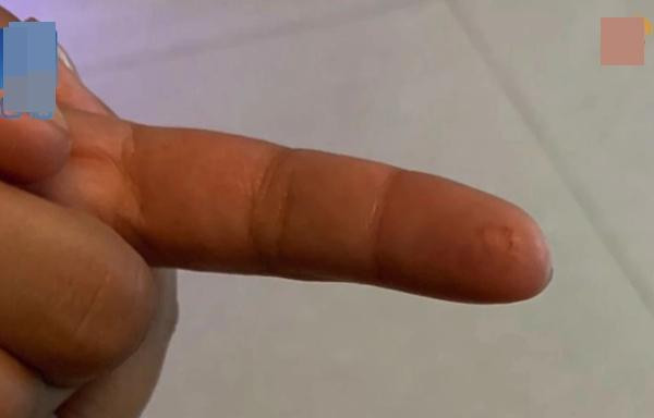 Ngón tay bị cua cắp. Ảnh: Weibo. Ngón tay bị cua cắp. Ảnh: Weibo.