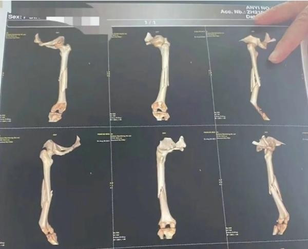 Cô Vương chia sẻ hình chụp cho thấy cô bị gãy xương đùi vì tập yoga. Ảnh: New QQ.