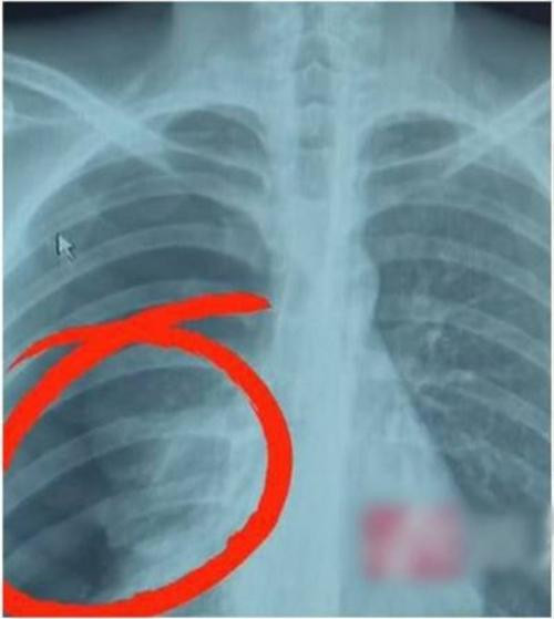 Vì hát nốt cao mà Wang bị tràn khí màng phổi. Ảnh: OD. Vì hát nốt cao mà Wang bị tràn khí màng phổi. Ảnh: OD.