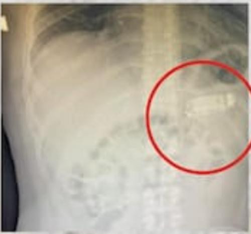 Phim chụp cho thấy "vật thể lạ" trong cơ thể bệnh nhân. Ảnh: Skender Telaku. Phim chụp cho thấy "vật thể lạ" trong cơ thể bệnh nhân. Ảnh: Skender Telaku.