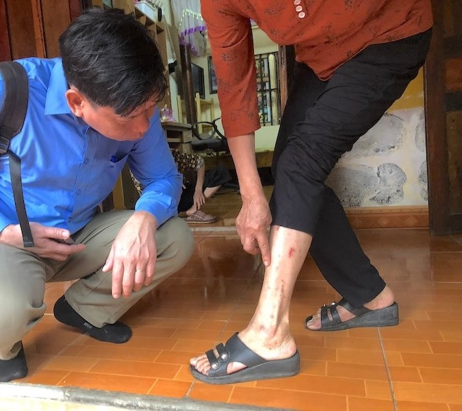 Liên tiếp 43 người trong một xóm bị sẩn ngứa chưa rõ nguyên nhân.