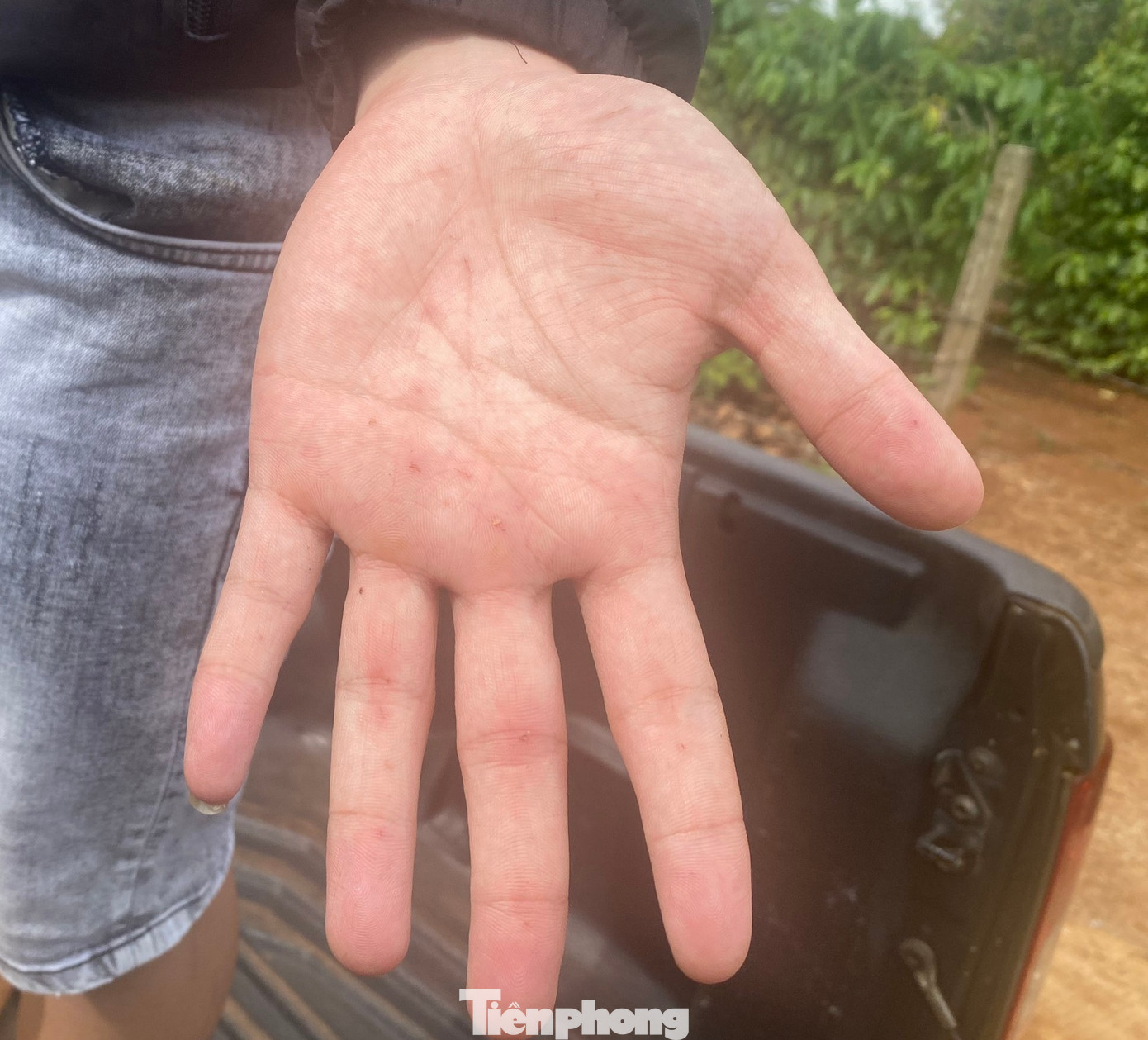 Bàn tay của Minh bị gai sầu riêng đâm xuyên 3 lớp bao tay vải