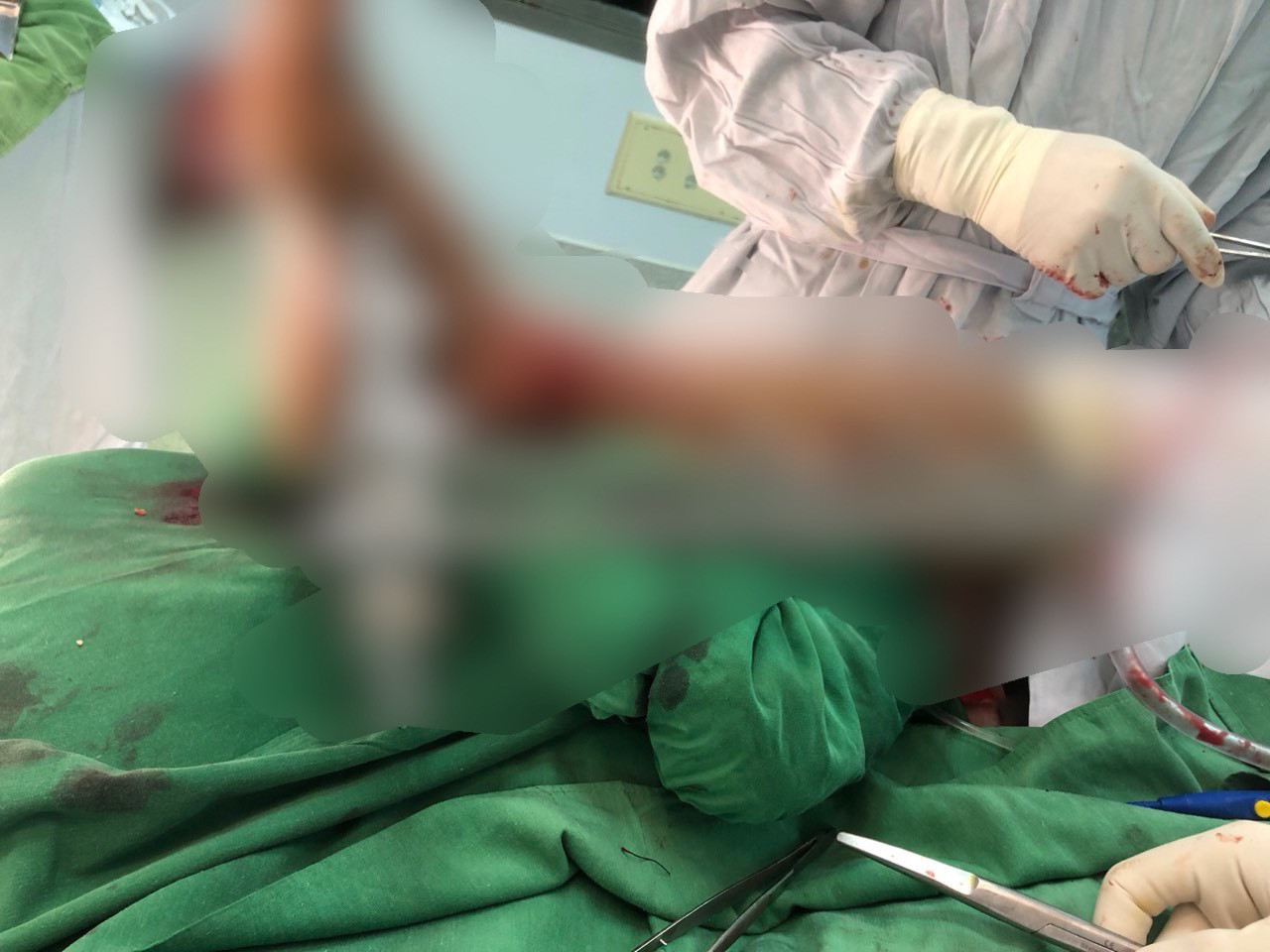 Cổ chân của nạn nhân bị máy cắt cỏ chém đứt lìa