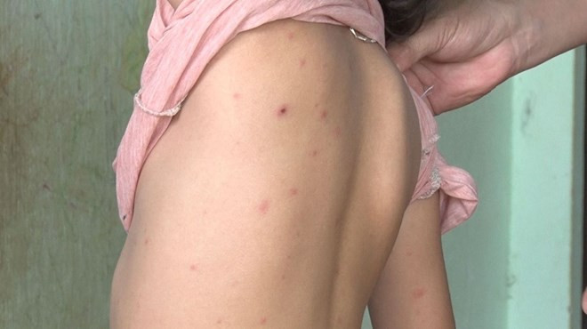 Một trường hợp nổi các mụn nước do mắc bệnh thủy đậu