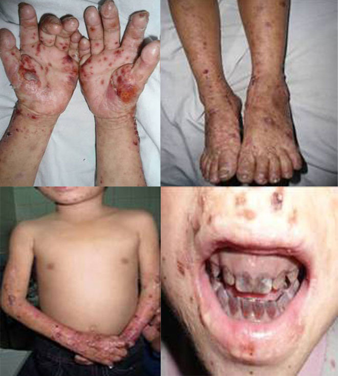 Hình ảnh tổn thương da và răng của bé Tr. Ảnh bác sĩ cung cấp