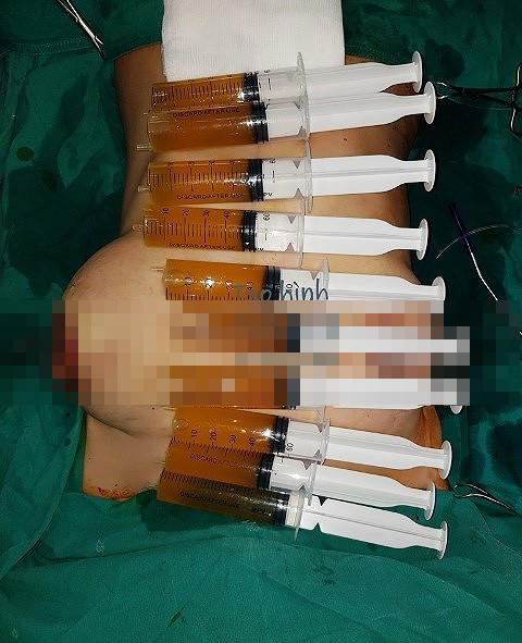 Ngực biến chứng căng như quả bóng, to nửa mét sau 'nâng cấp' ảnh 1