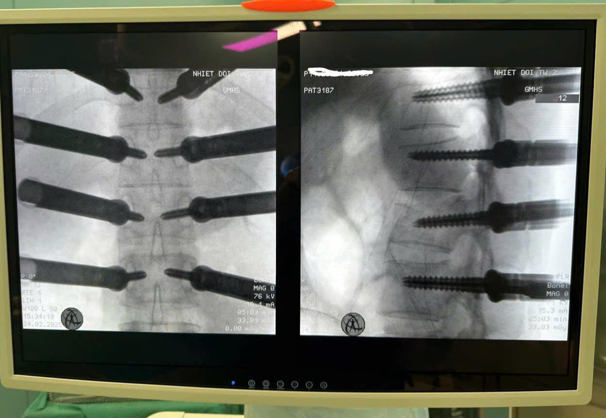 Hình ảnh cột sống đã được bắt vít. Ảnh: Bệnh viện cung cấp Hình ảnh cột sống đã được bắt vít. Ảnh: Bệnh viện cung cấp