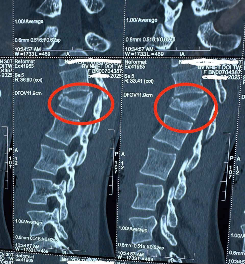Hình ảnh cột sống của bệnh nhân. Ảnh: Bệnh viện cung cấp Hình ảnh cột sống của bệnh nhân. Ảnh: Bệnh viện cung cấp