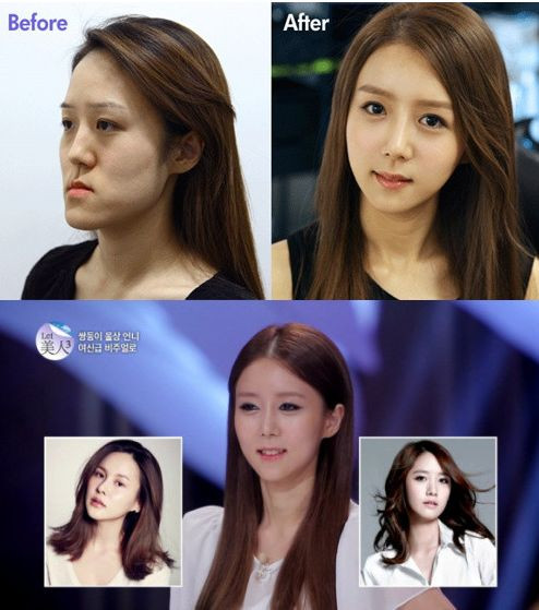 Khuôn mặt xinh đẹp của Bang Mi Jung sau phẫu thuật. Khuôn mặt xinh đẹp của Bang Mi Jung sau phẫu thuật